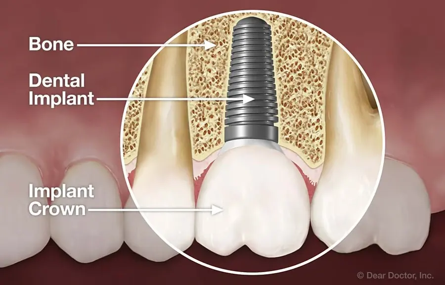 Dental Implants at East Greenwich Dental Associates, East Greenwich, Rhode Island.